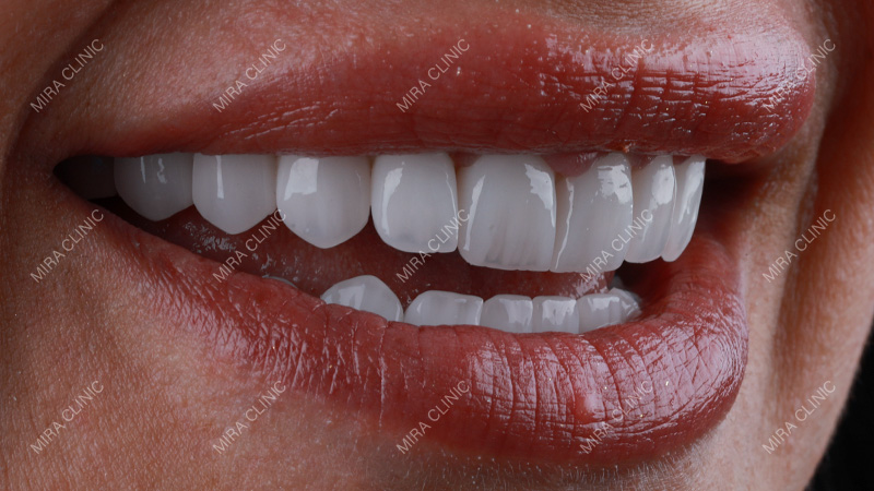 Hollywood Smile Plan Changed After X-Rays